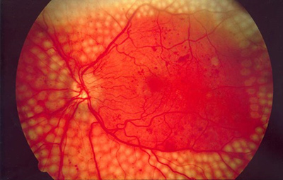 یک چربی موثر در پیشگیری از ابتلا به بیماری چشم دیابتیک کشف شد